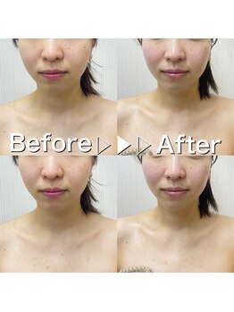 ビオルブ(VIOLVE)/小顔リフトフェイシャル