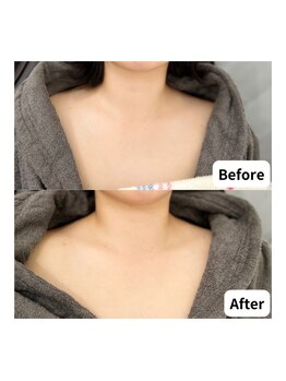 サロン コムモア(salon COMME MOI)/【デコルテケア】BeforeAfter
