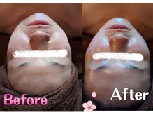 ムーンブロッサム(MoonBlossom)/エラ張り解消小顔キャビ+手技