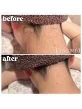 ウィンクドール(Wink Doll)/うなじ脱毛