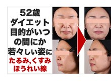 ボディアーキ 中野店(BODY ARCHI)/ほうれい線　たるみ　くすみ