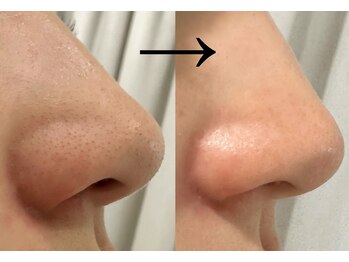 ビズビズ(bizz bizz)/ララピール圧倒的毛穴レス