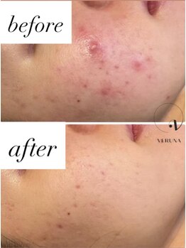 アトワ(A toi)/ハーブピーリング(棘あり)