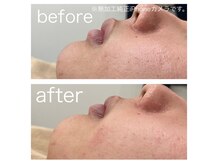 ラクシー 北千住(luxssy)/口元シェービング