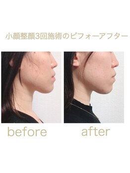 マナレア(Manalea)/受け口も改善！