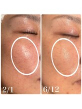 楚々(SOSO)/before after4回目