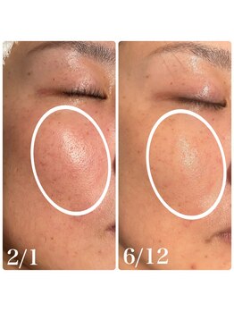 楚々(SOSO)/before after4回目