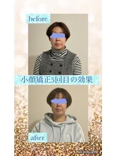 オスベル(OSBELLE)/小顔矯正