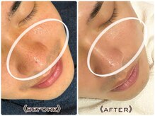 オプス ライフビューティー(OPS×LIFE BEAUTY)/メンズフェイシャルエステ