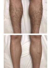 レヴール(reveur)/足脱毛[美容脱毛/新潟脱毛]