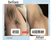 ユシェリア(Yucheria)/メンズわき脱毛経過