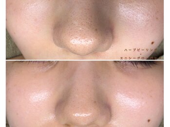 ルリエベル(Relier Belle)の写真/黒ずみ・詰まり・開き毛穴を徹底ケア◎つるんとなめらかなツヤ肌へ♪