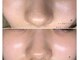 ルリエベル(Relier Belle)の写真/黒ずみ・詰まり・開き毛穴を徹底ケア◎つるんとなめらかなツヤ肌へ♪