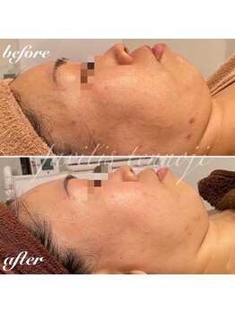 ファビリス 天王寺店(FAVILIS)/ACトリートメント3回/30代