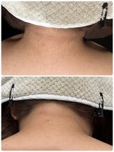 ハチ シンス 2023-(hachi-since 2023-)/うなじ脱毛　Before・After