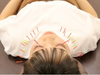 竹ノ塚喜楽鍼灸接骨院/施術風景（美容鍼）