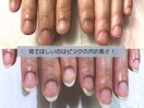 深爪矯正から更に美しく美爪強化