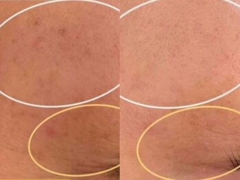 ラエッセ 恵比寿(LAESSE)/毛穴・美白専門店 LAESSE 恵比寿