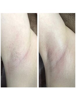 ハレノヒ(HaLeNoHi)/【ブラジリアンワックス】