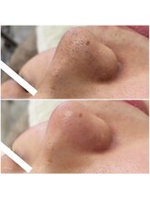 メゾンリュバン 梅田店(Maison Ruban)/毛穴洗浄・美白フォト|毛穴ケア