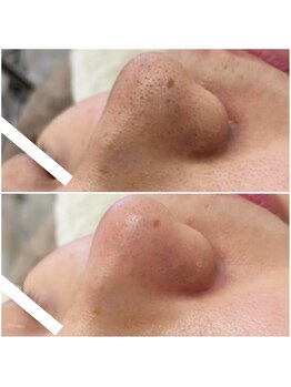 メゾンリュバン 梅田店(Maison Ruban)/毛穴洗浄・美白フォト|毛穴ケア