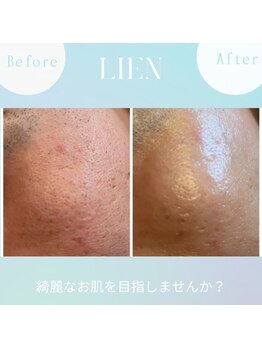 リアン(LIEN)/キメが整ってお肌の潤いUP