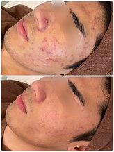 ビオエル 横浜店(Bioel)/ハーブピーリング/横浜