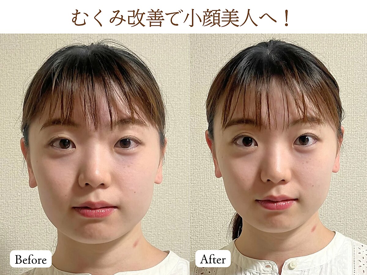 【むくみ・エラ張り】リフトアップ小顔矯正★頭蓋骨矯正＆首肩こりケアまで