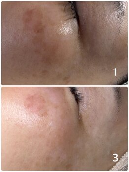 レア(le'a)/頬のシミがお悩み