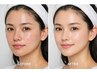 新規｜毛穴・くすみ改善◎ハーブピーリング＋毛穴洗浄 ￥7,800