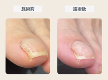 ルポ 伊勢/巻き爪ケア