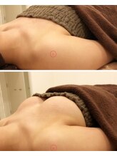 リール 新宿店(RIRE)/30代後半　バストアップ症例