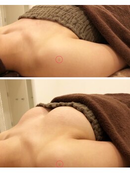 リール 新宿店(RIRE)/30代後半 バストアップ症例