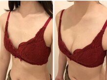 リール 恵比寿店(RIRE)/バストアップ症例【広尾恵比寿】