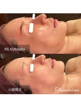 サンベリーナ(Thumbelina)/小顔矯正