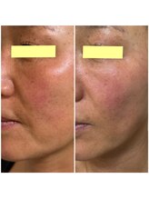 スプレール 水戸店/ExoLif（エクソリフト）