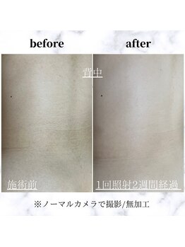 エルアンドエル(L&L)/見えない背中大丈夫?