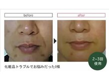 レスト 大宮店(REST)/ハーブピーリング効果２