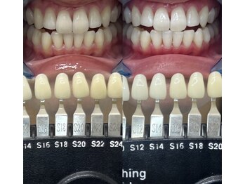 トウキョウスワーズ 池袋店(TOKYO SWRS)/#ホワイトニング #池袋 #渋谷