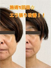 リル(LIL)/オーダーメイド小顔調整