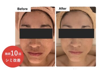 エン(O'en)/エクソソーム＋幹細胞導入ケア♪