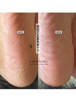 ココロ(COCORO)/韓国式足裏角質ケア