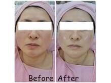 リアウェイク(Reawayke)/ララピール　ビフォーアフター◎