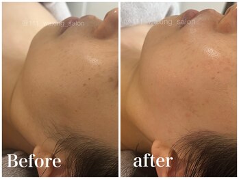 トリプルワン(111)/クラニオフェイシャルワックス