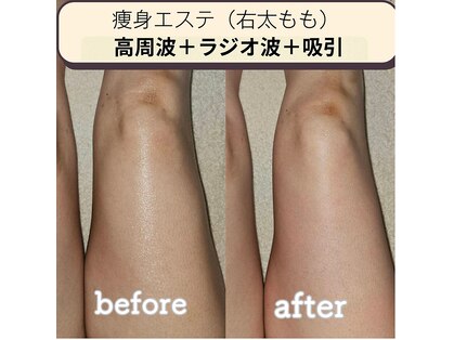 リラ プラス(Lila+)の写真