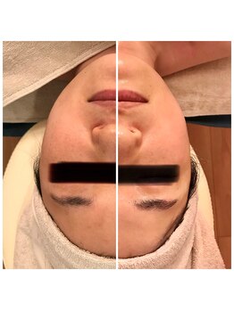 ルミリラ(lumi.Lyra)/あたりが強くないストーンかっさ