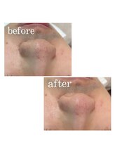 リンク(LINK)/小鼻WAX