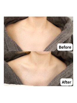サロン コムモア(salon COMME MOI)/【デコルテケア】BeforeAfter