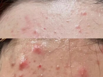 ラエッセ 恵比寿(LAESSE)/毛穴・美白専門店 LAESSE 恵比寿