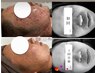【ガリレオピーリング】ダウンタイム最小限！角質ケア+肌育を同時に☆